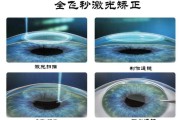 飞秒激光矫正近视要多少钱(做飞秒激光近视手术大概多少钱)