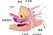 诊刮后一星期又出血(诊刮后止血后一星期又出血)