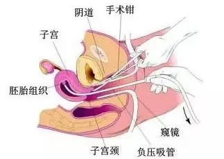 诊刮后一星期又出血(诊刮后止血后一星期又出血)